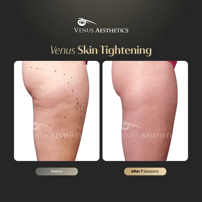 Non-surgical skin tightening and firming before and after photo of an actual Venus Aesthetics client, 16 of 16
