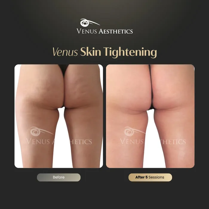 Non-surgical skin tightening and firming before and after photo of an actual Venus Aesthetics client, 2 of 16