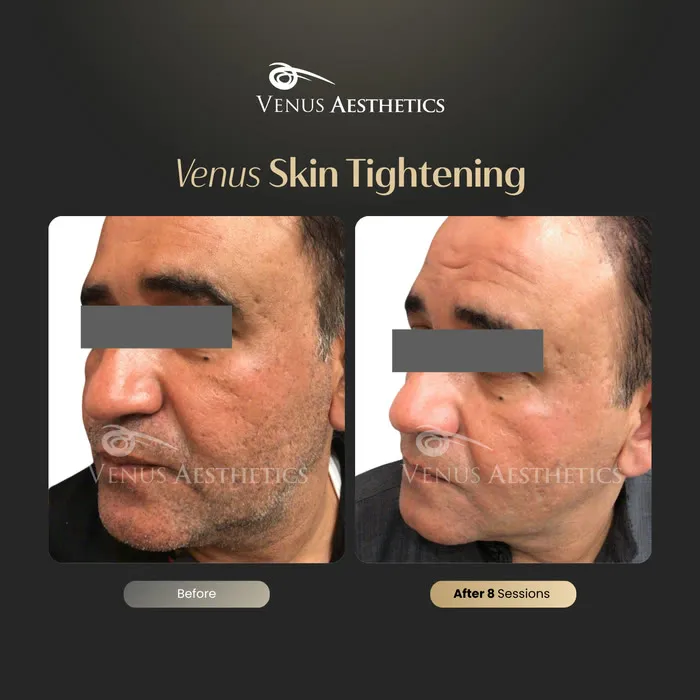 Non-surgical skin tightening and firming before and after photo of an actual Venus Aesthetics client, 3 of 16