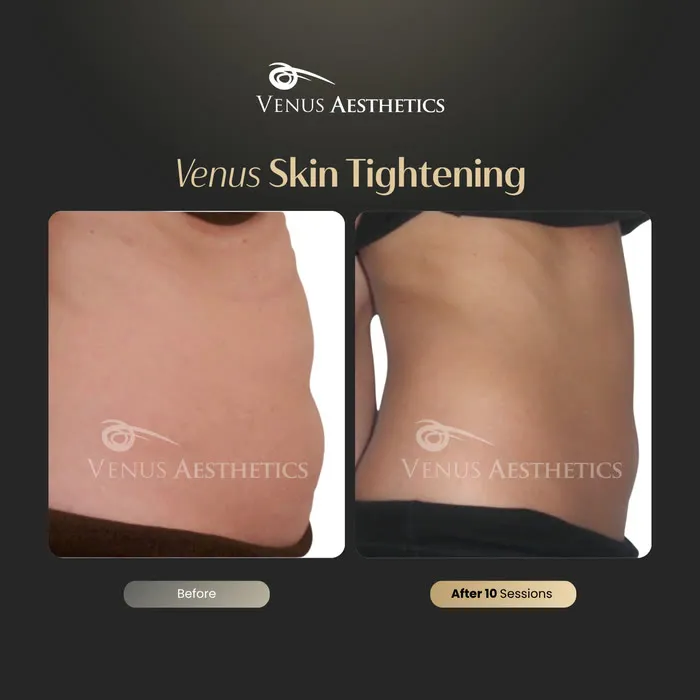 Non-surgical skin tightening and firming before and after photo of an actual Venus Aesthetics client, 4 of 16