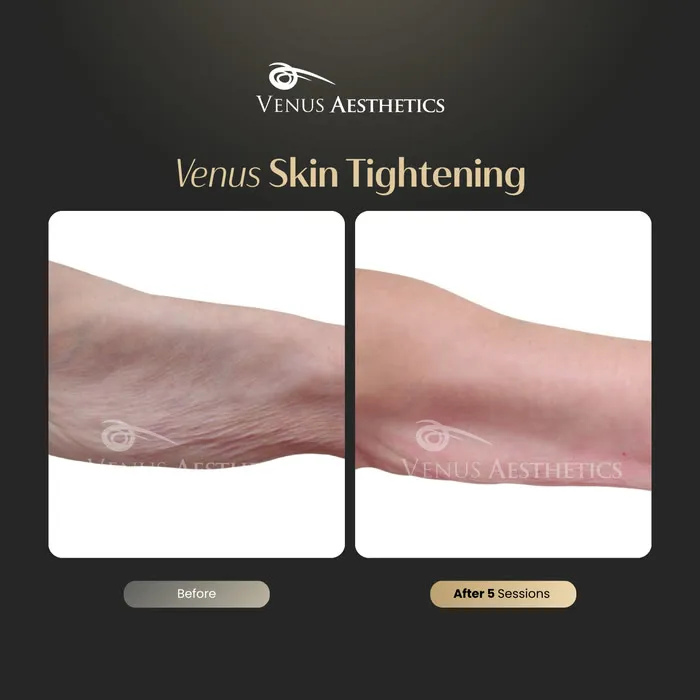 Non-surgical skin tightening and firming before and after photo of an actual Venus Aesthetics client, 5 of 16