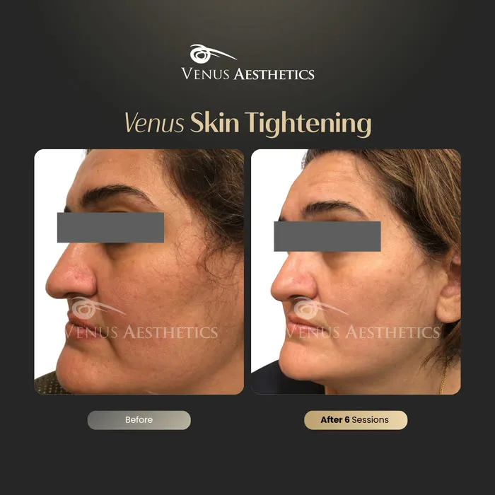 Neck lift before and after result at Venus Aesthetics