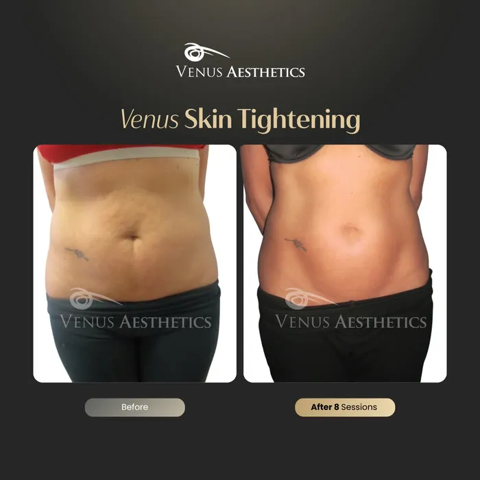 Neck lift before and after result at Venus Aesthetics