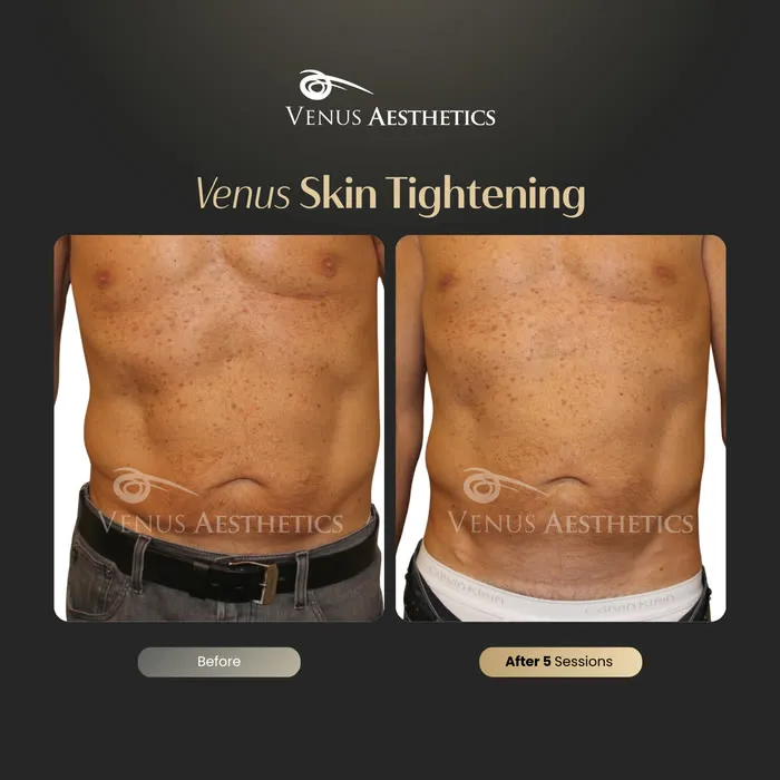 Non-surgical skin tightening and firming before and after photo of an actual Venus Aesthetics client, 8 of 16