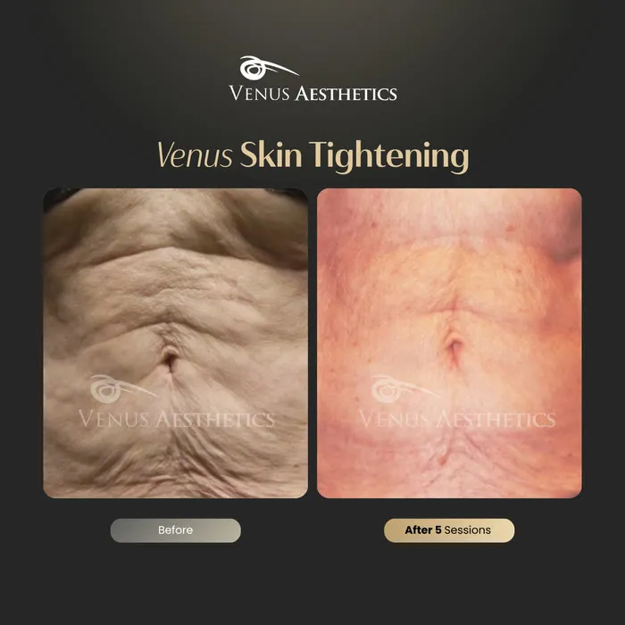 Non-surgical skin tightening and firming before and after photo of an actual Venus Aesthetics client, 9 of 16