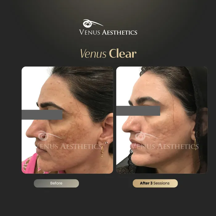 Venus Clear pigmentation treatment before and after photo of an actual Venus Aesthetics client, 1 of 16