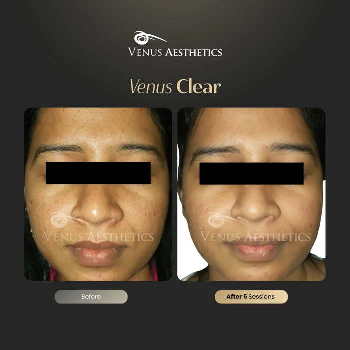 Venus Clear pigmentation treatment before and after photo of an actual Venus Aesthetics client, 10 of 16