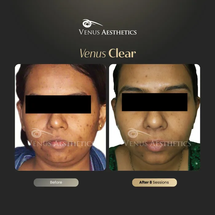 Venus Clear pigmentation treatment before and after photo of an actual Venus Aesthetics client, 11 of 16