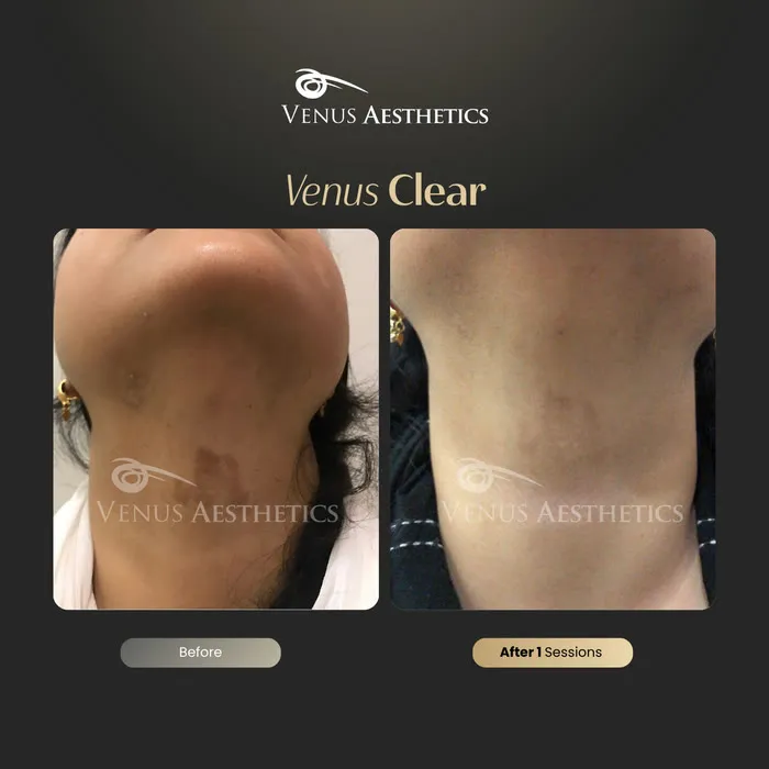 Venus Clear pigmentation treatment before and after photo of an actual Venus Aesthetics client, 12 of 16