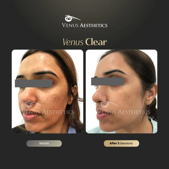 Venus Clear pigmentation treatment before and after photo of an actual Venus Aesthetics client, 13 of 16
