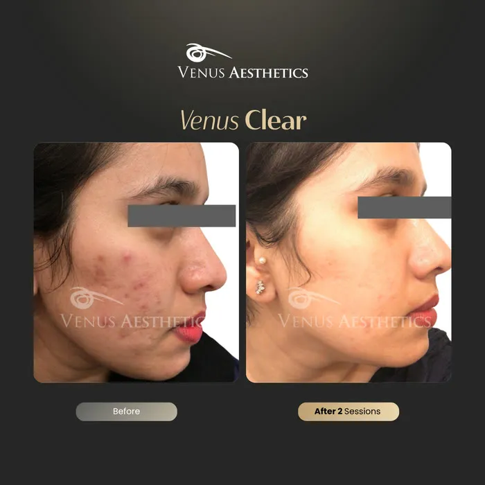 Venus Clear pigmentation treatment before and after photo of an actual Venus Aesthetics client, 14 of 16