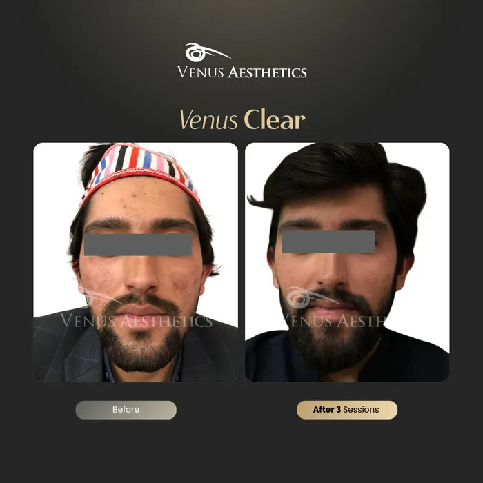 Venus Clear pigmentation before and after result at Venus Aesthetics