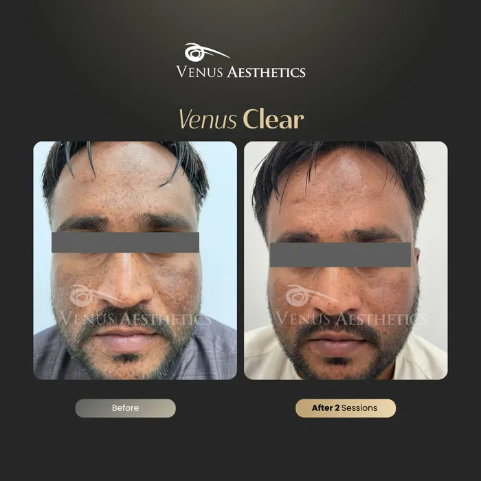 Venus Clear pigmentation treatment before and after photo of an actual Venus Aesthetics client, 16 of 16