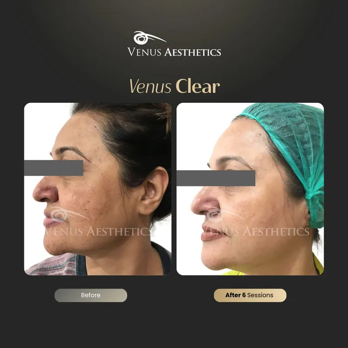 Venus Clear pigmentation treatment before and after photo of an actual Venus Aesthetics client, 2 of 16