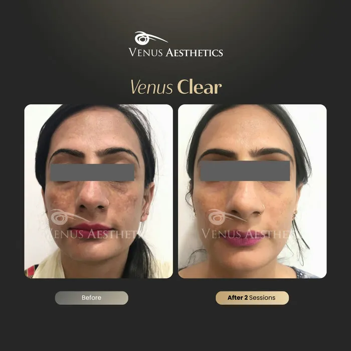 Venus Clear pigmentation treatment before and after photo of an actual Venus Aesthetics client, 3 of 16