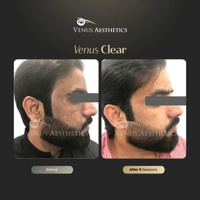 Venus Clear pigmentation treatment before and after photo of an actual Venus Aesthetics client, 4 of 16