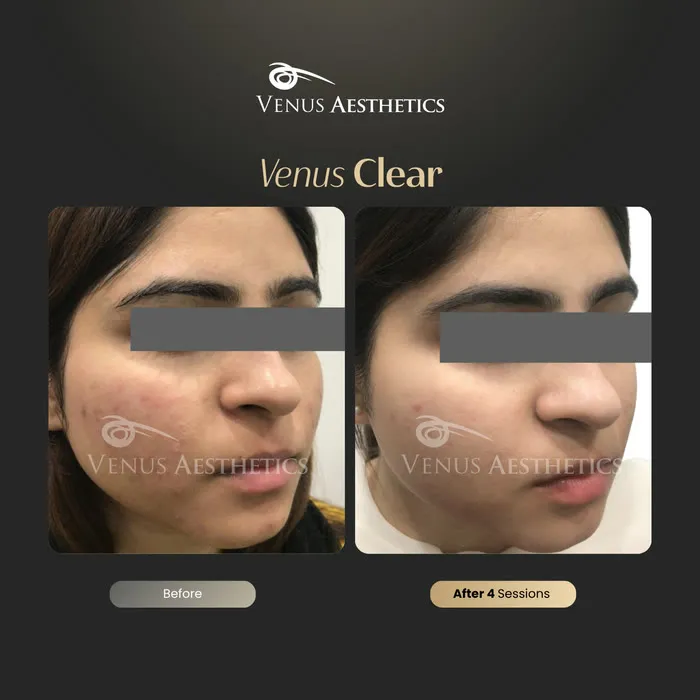 Venus Clear pigmentation before and after result at Venus Aesthetics