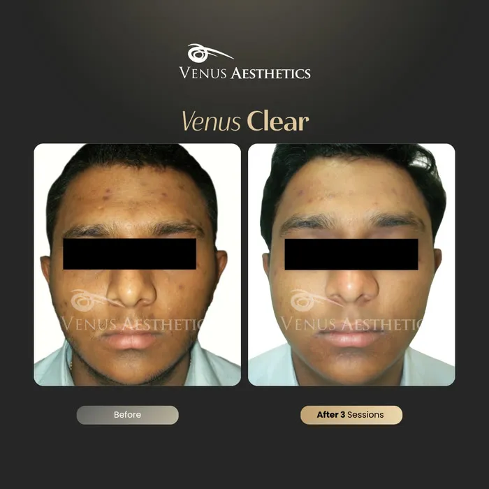 Venus Clear pigmentation before and after result at Venus Aesthetics