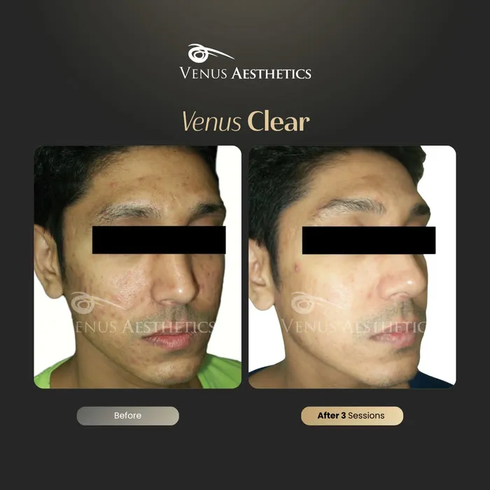 Venus Clear pigmentation before and after result at Venus Aesthetics
