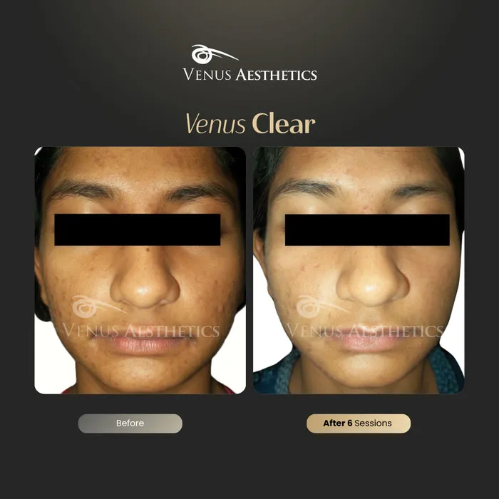 Venus Clear pigmentation treatment before and after photo of an actual Venus Aesthetics client, 8 of 16