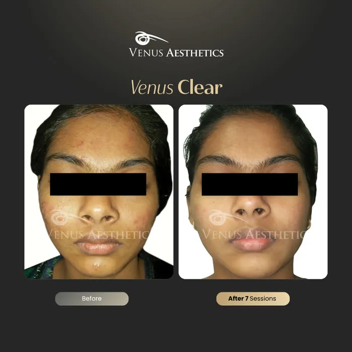 Venus Clear pigmentation treatment before and after photo of an actual Venus Aesthetics client, 9 of 16