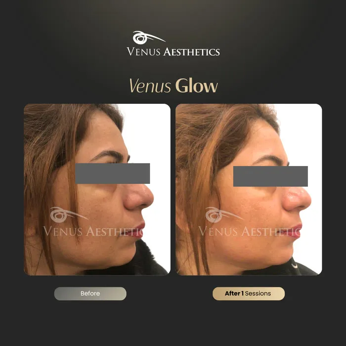 Venus Glow Facial (HydraFacial) before and after photo of an actual Venus Aesthetics client, 1 of 7