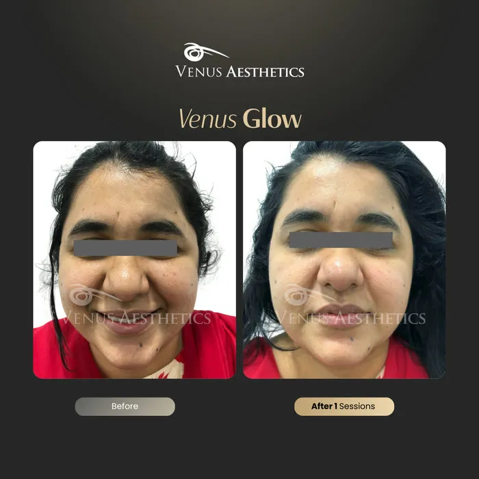 Venus Glow facial before and after result at Venus Aesthetics