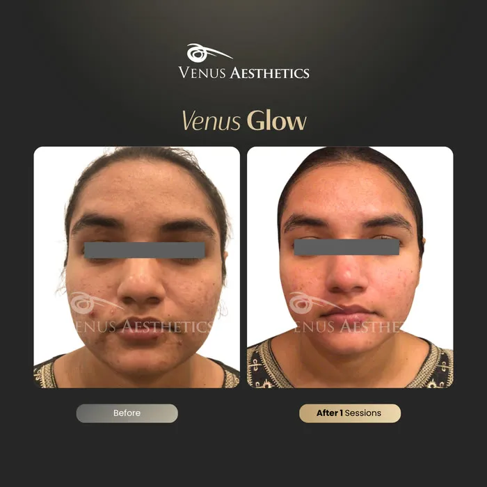Venus Glow facial before and after result at Venus Aesthetics