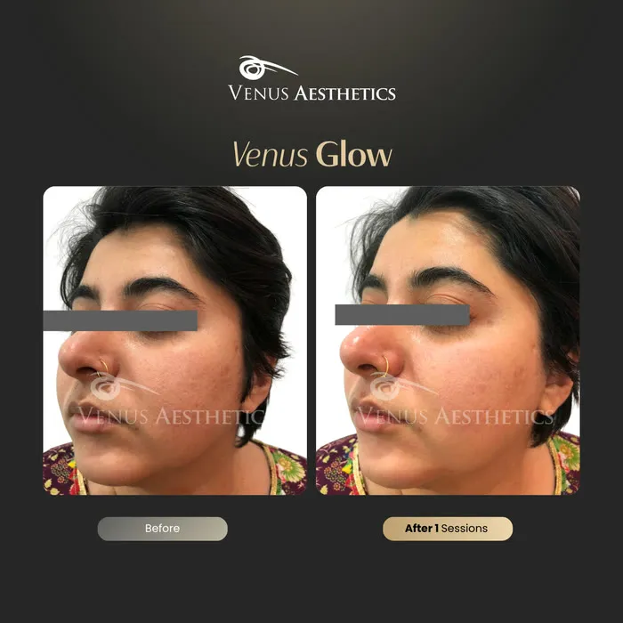 Venus Glow Facial (HydraFacial) before and after photo of an actual Venus Aesthetics client, 4 of 7