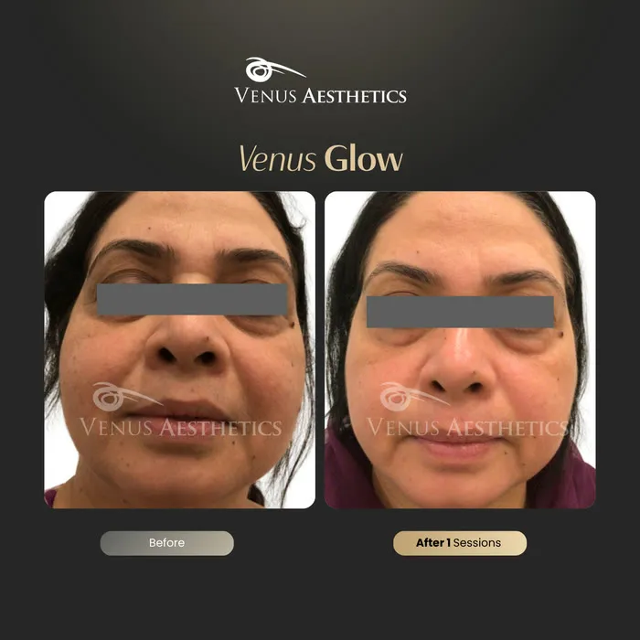Venus Glow Facial (HydraFacial) before and after photo of an actual Venus Aesthetics client, 5 of 7