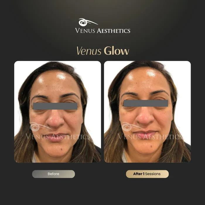 Venus Glow Facial (HydraFacial) before and after photo of an actual Venus Aesthetics client, 6 of 7