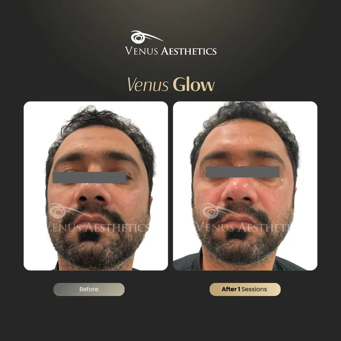 Venus Glow facial before and after result at Venus Aesthetics