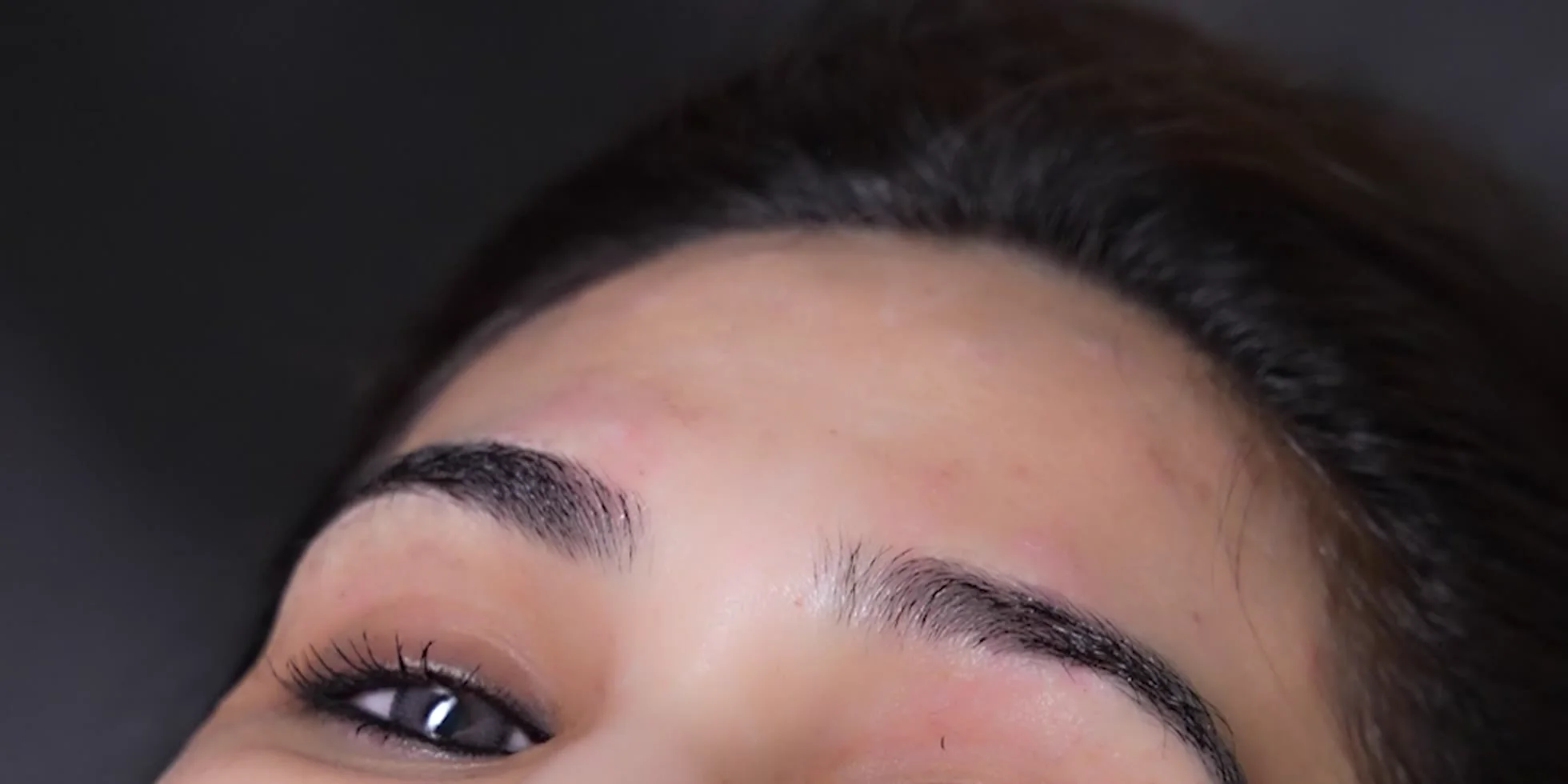 Close-up of a smooth forehead and brow after Botox at Venus Aesthetics