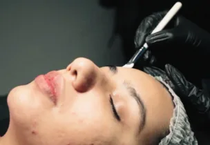 AcneOUT Peel at Venus Aesthetics