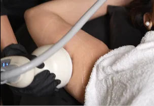 Upper-Arm Firming (Bingo Wings) at Venus Aesthetics