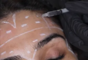 Forehead & Frown Lines at Venus Aesthetics