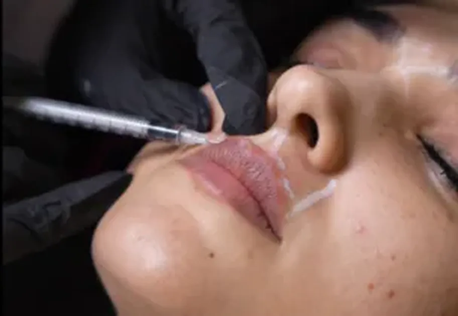 Lip Flip at Venus Aesthetics