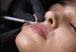 Lip Flip at Venus Aesthetics