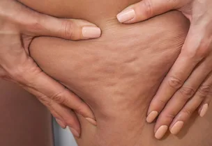 Cellulite Treatment at Venus Aesthetics