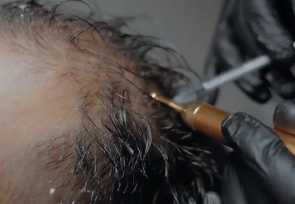 Hair Mesotherapy at Venus Aesthetics
