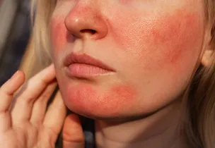 Rosacea & Redness at Venus Aesthetics