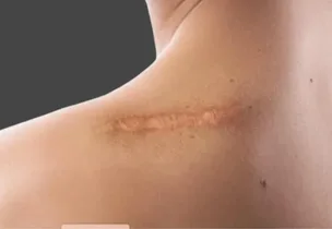 Venus Scar Free for Surgical & Traumatic Scars at Venus Aesthetics