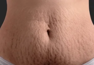 Venus Stretch Mark Treatment at Venus Aesthetics