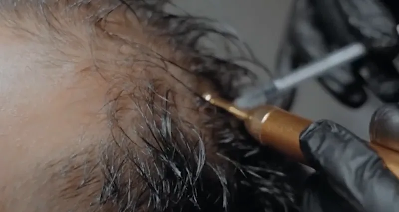 A doctor giving scalp micro-injections at Venus Aesthetics