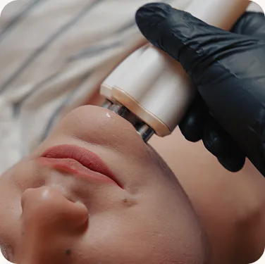 Gummy smile correction at Venus Aesthetics